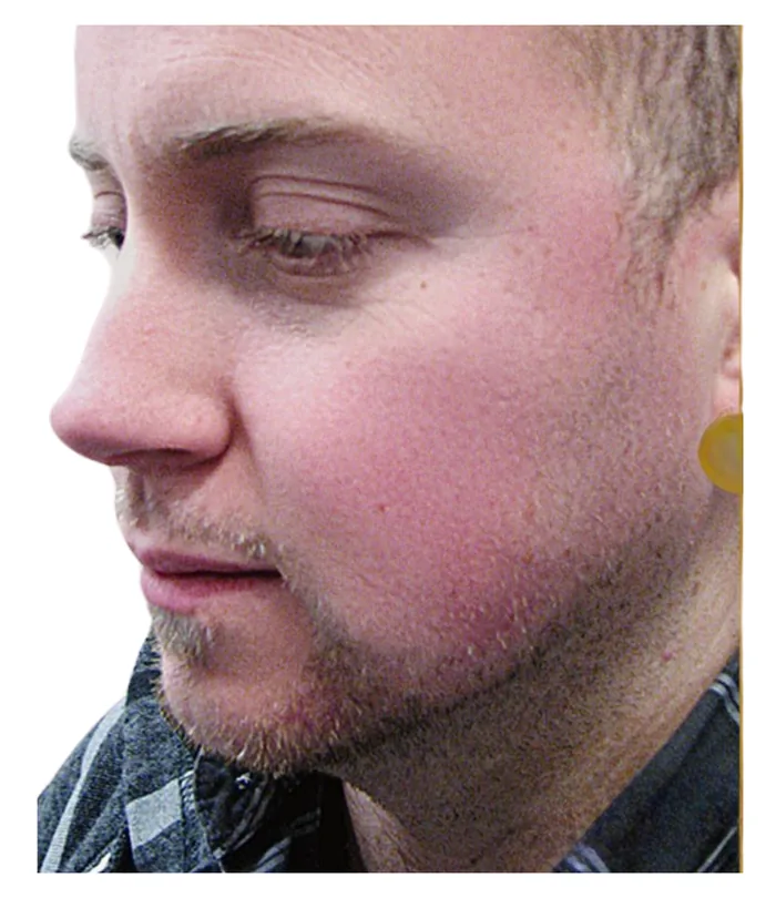 Beard transplant before, case 032