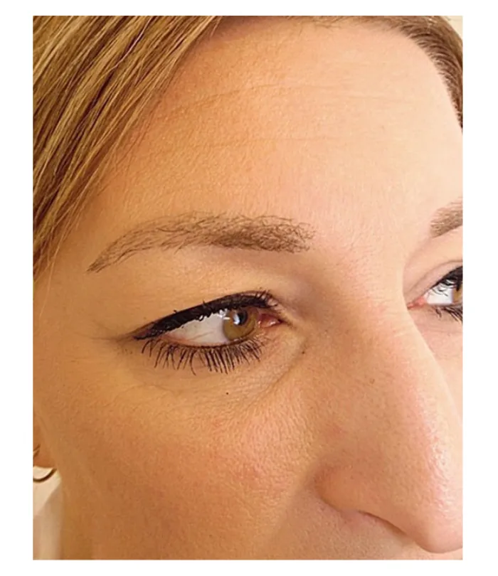 Eyebrow transplant 12 months after, case 033