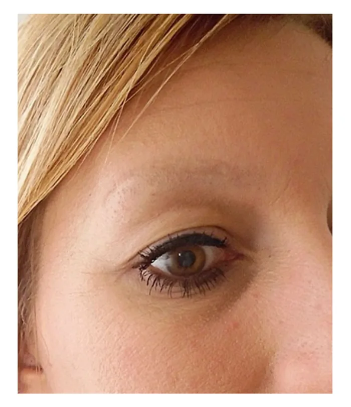 Eyebrow transplant before, case 033