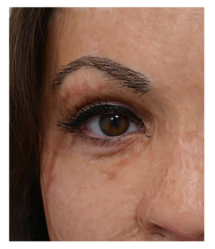 Eyebrow transplant 12 months after, case 034