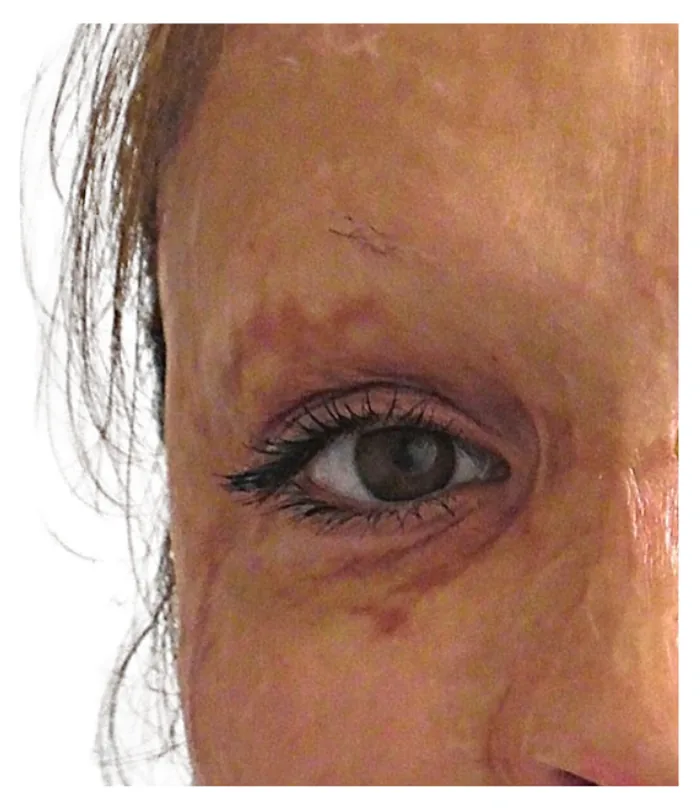 Eyebrow transplant before, case 034