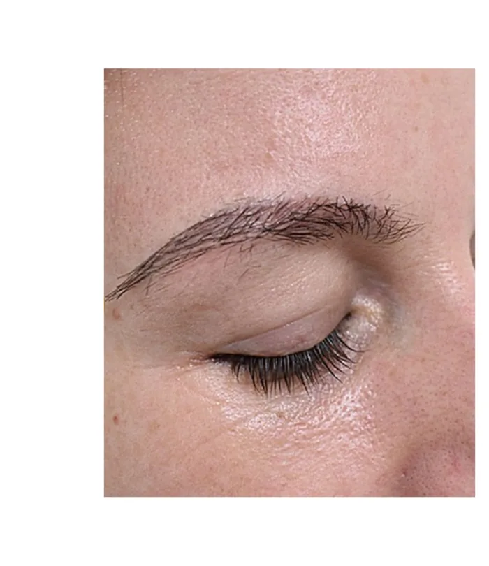 Eyebrow transplant 12 months after, case 035