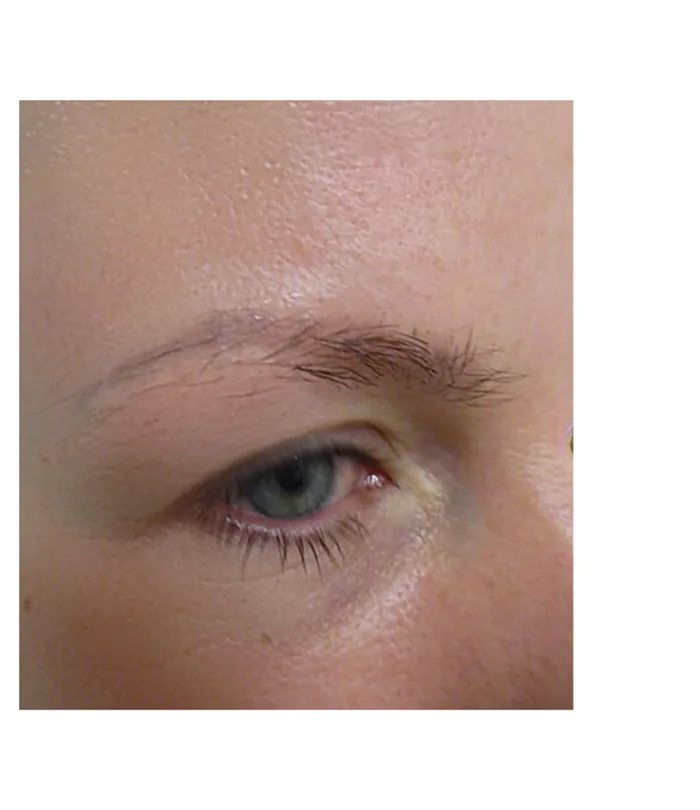Eyebrow transplant before, case 035