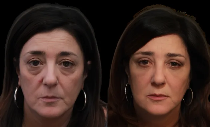 Blepharoplasty before and after supplied as one composite frame, BLPH-002