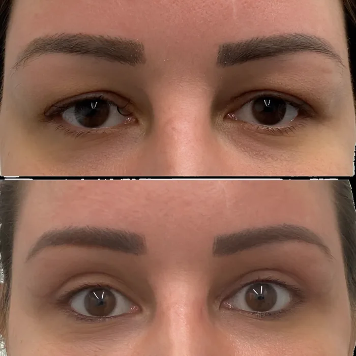 Blepharoplasty before and after supplied as one composite frame, BLPH-003