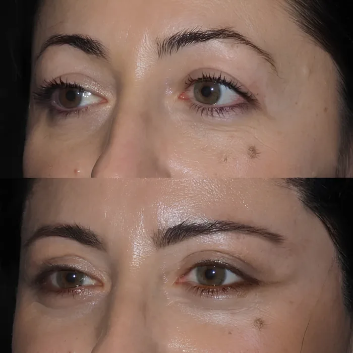 Blepharoplasty before and after supplied as one composite frame, BLPH-004