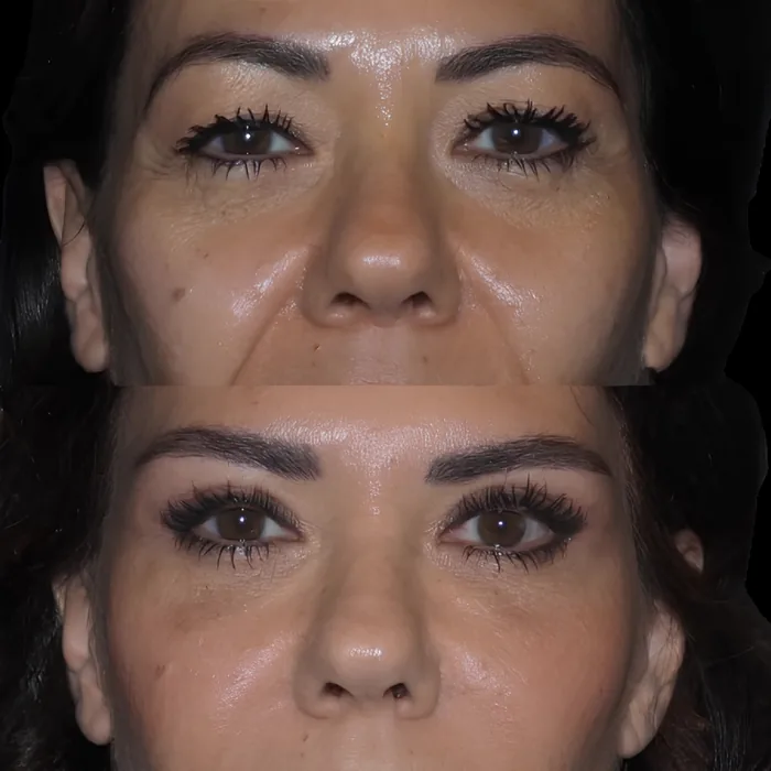 Blepharoplasty before and after supplied as one composite frame, BLPH-005