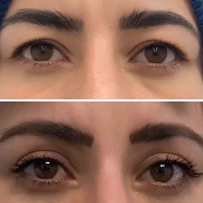 Blepharoplasty before and after supplied as one composite frame, BLPH-006