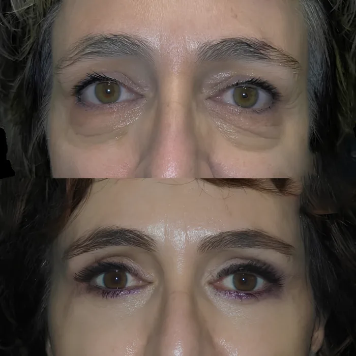Blepharoplasty before and after supplied as one composite frame, BLPH-007