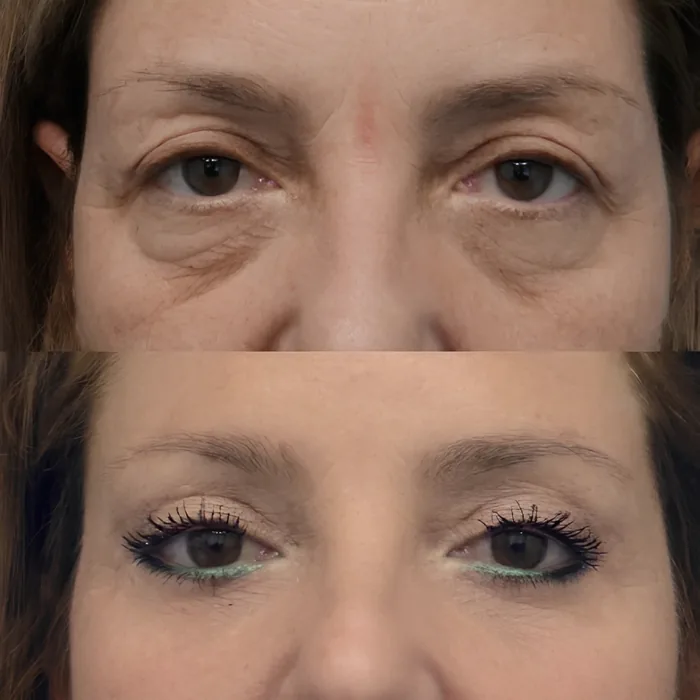 Blepharoplasty before and after supplied as one composite frame, BLPH-008