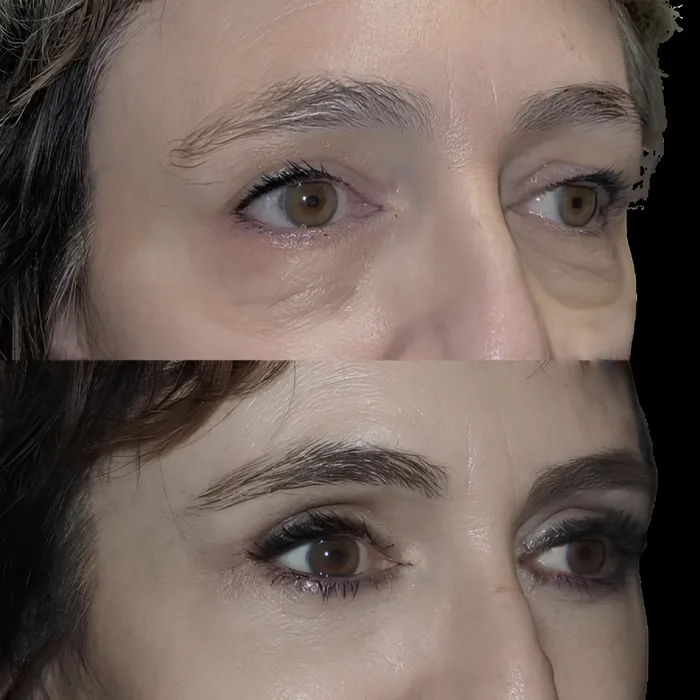 Blepharoplasty before and after supplied as one composite frame, BLPH-009