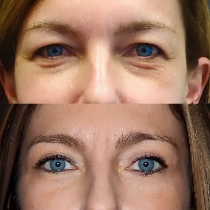 Blepharoplasty before and after supplied as one composite frame, BLPH-010