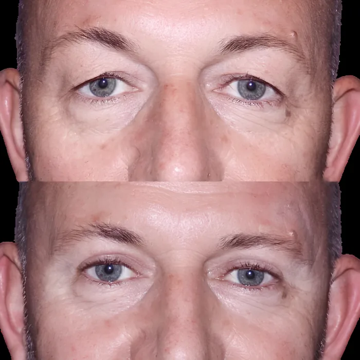 Blepharoplasty before and after supplied as one composite frame, BLPH-011