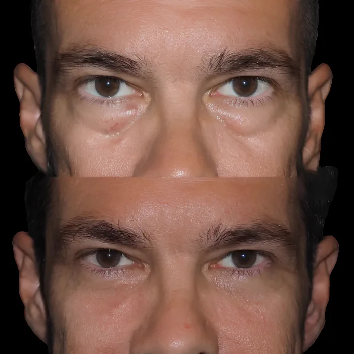 Blepharoplasty before and after supplied as one composite frame, BLPH-012