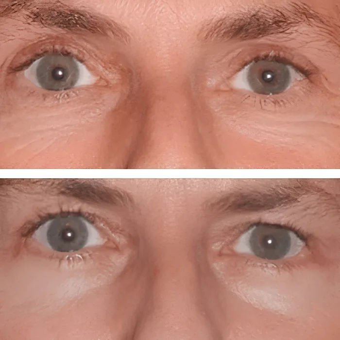 Blepharoplasty before and after supplied as one composite frame, BLPH-013
