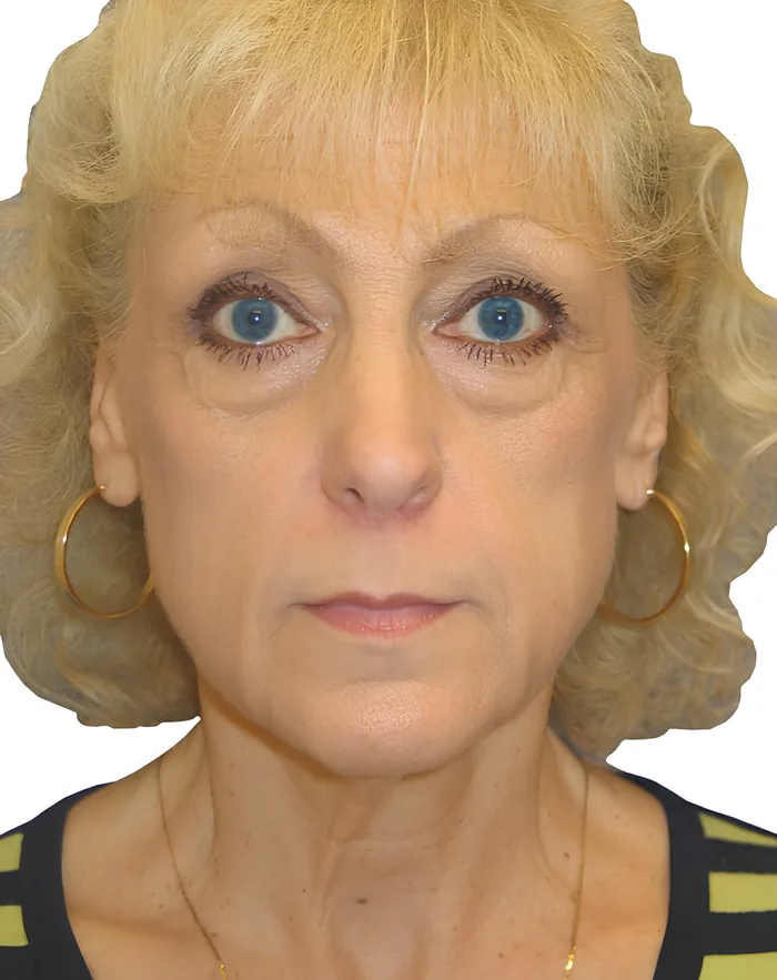 Facelift front after, FACE-001