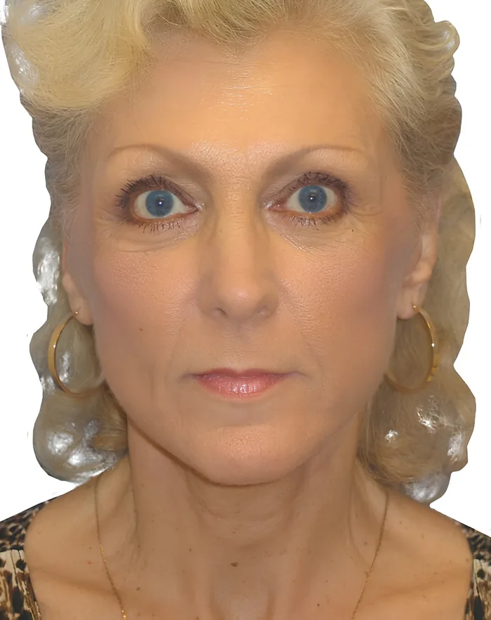 Facelift front before, FACE-001
