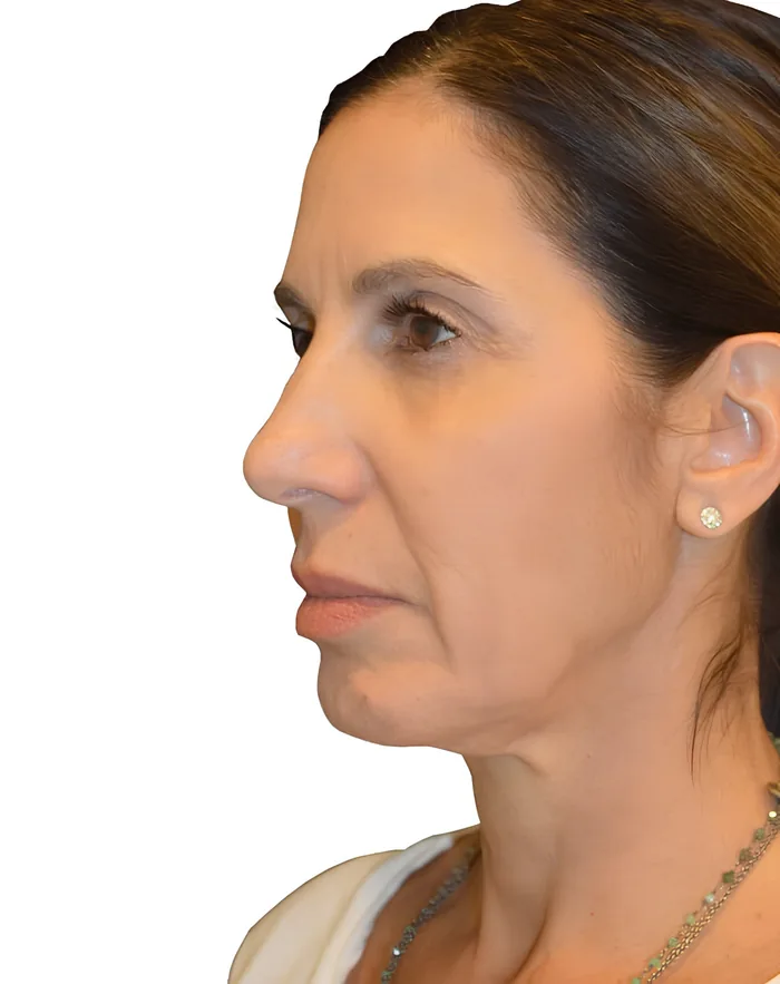 Facelift profile before, FACE-002