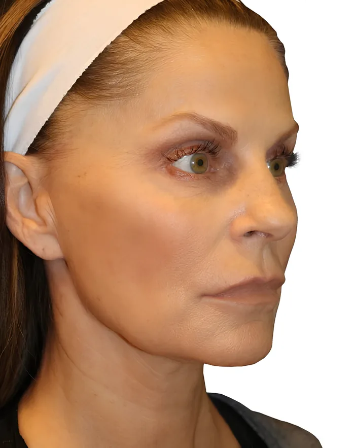 Facelift front after, FACE-003