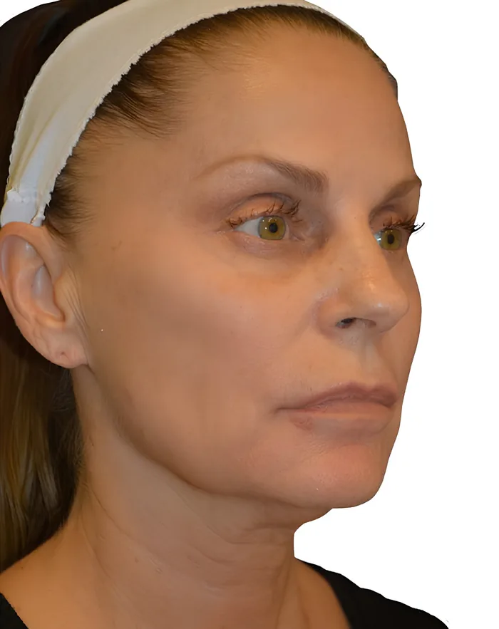 Facelift front before, FACE-003