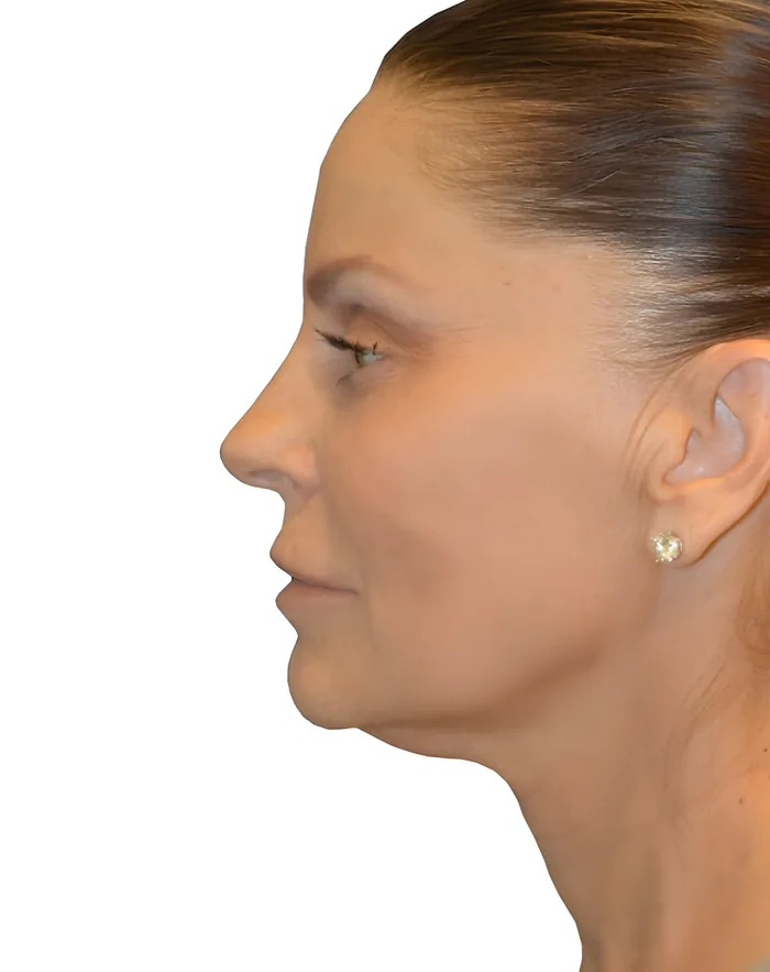 Facelift profile after, FACE-003