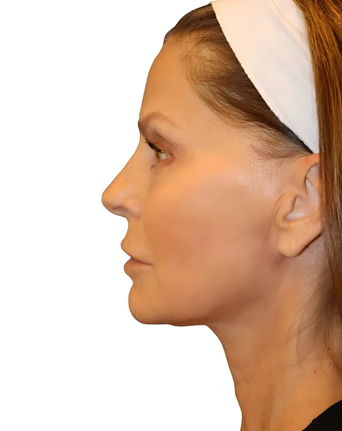 Facelift profile before, FACE-003