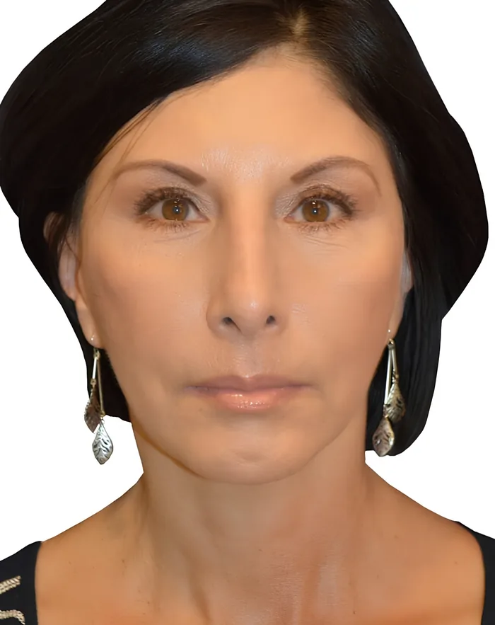 Facelift front after, FACE-004