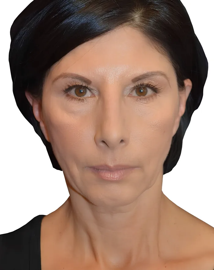 Facelift front before, FACE-004