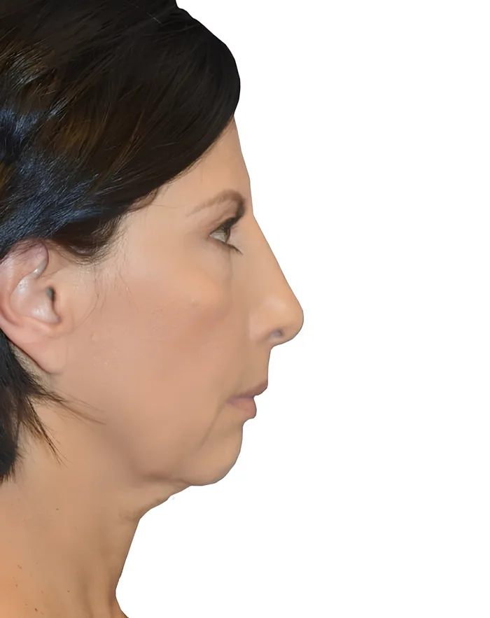 Facelift profile after, FACE-004