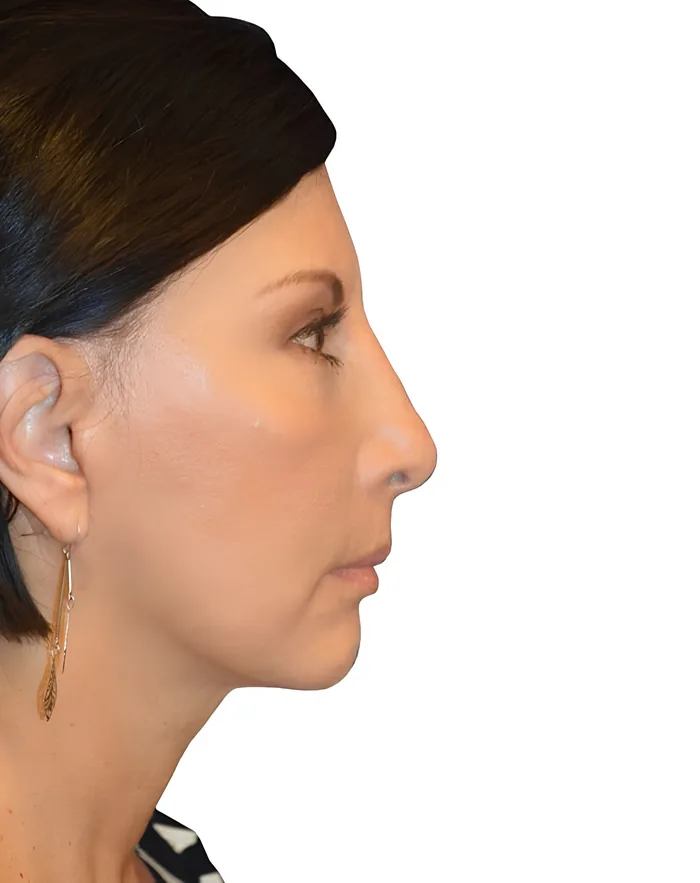 Facelift profile before, FACE-004