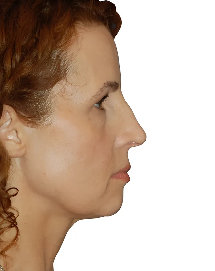 Facelift profile after, FACE-005