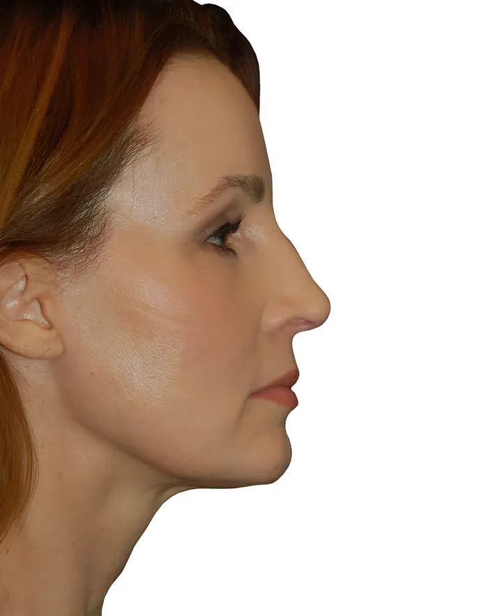 Facelift profile before, FACE-005