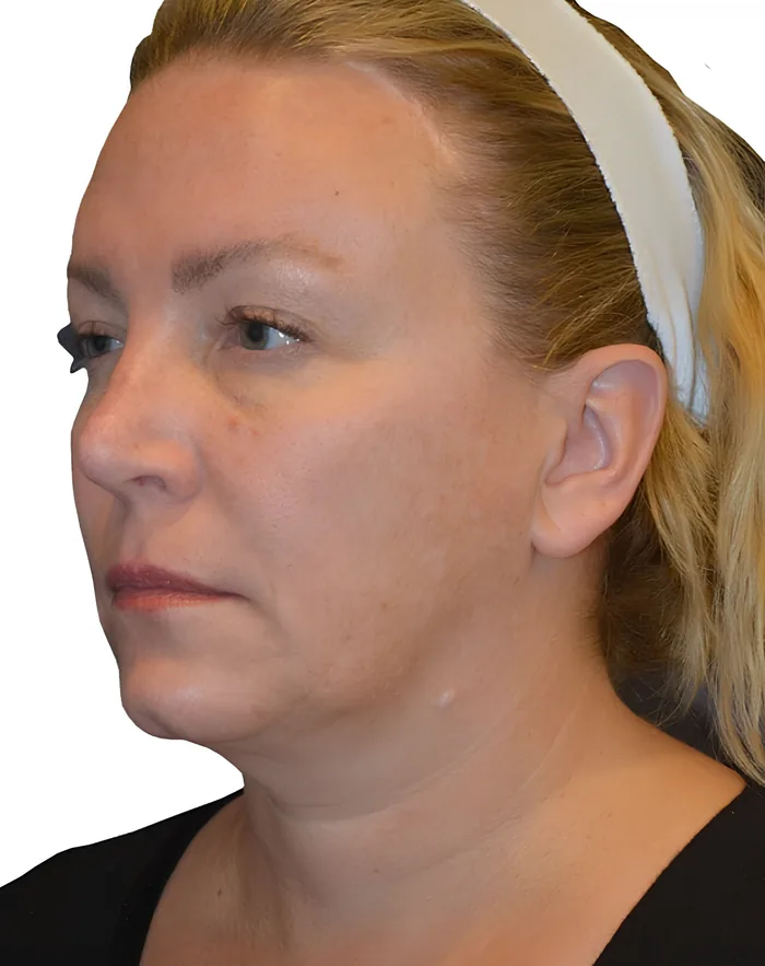 Facelift profile after, FACE-007