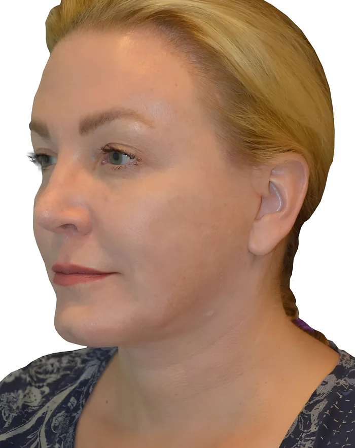 Facelift profile before, FACE-007