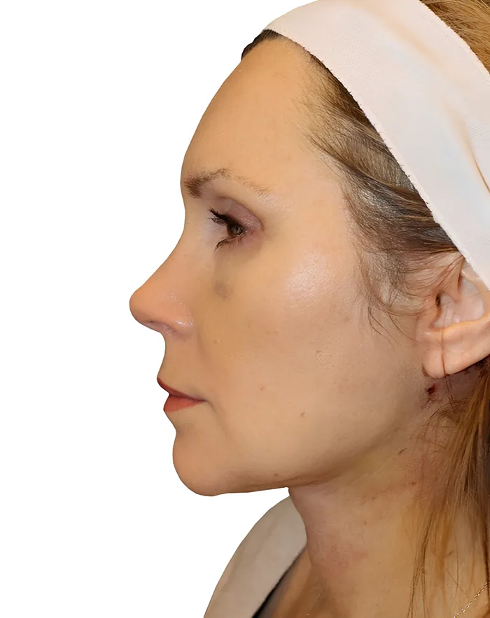 Facelift profile after, FACE-008