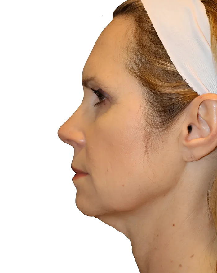 Facelift profile before, FACE-008