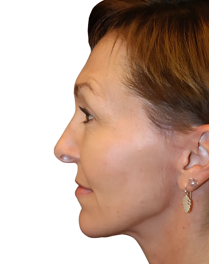 Facelift profile after, FACE-010