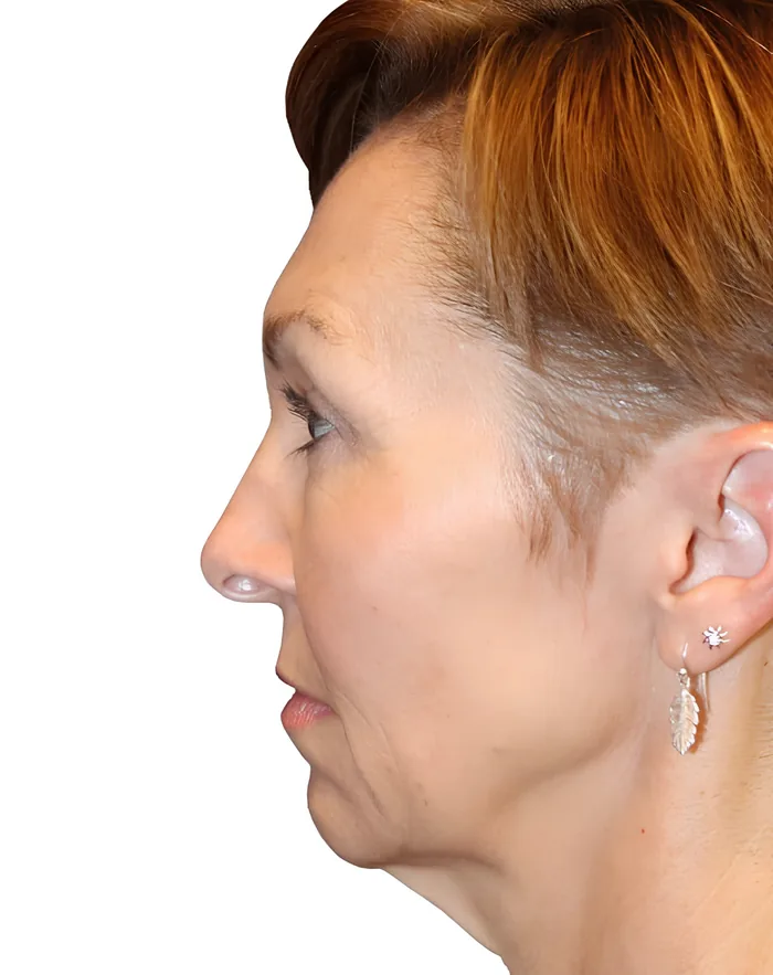 Facelift profile before, FACE-010