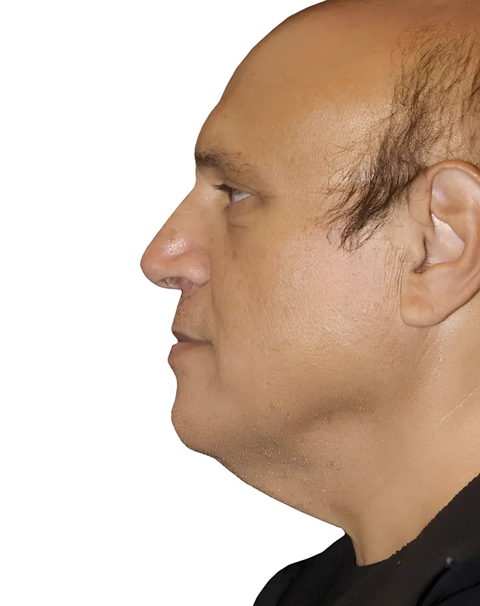 Facelift profile after, FACE-011
