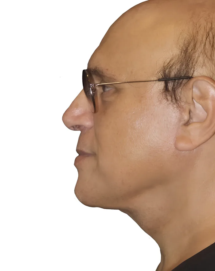 Facelift profile before, FACE-011