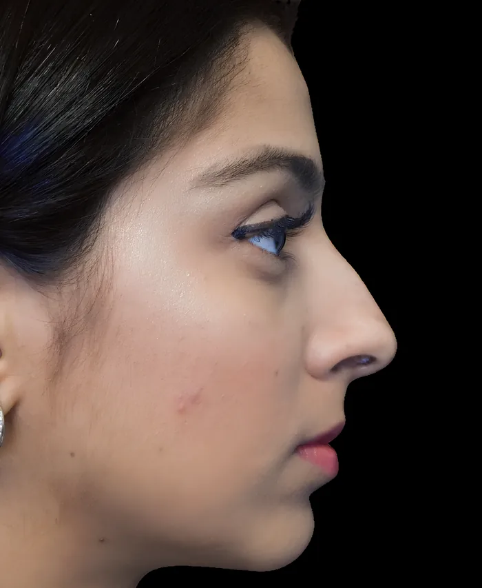 Rhinoplasty after, RHIN-001