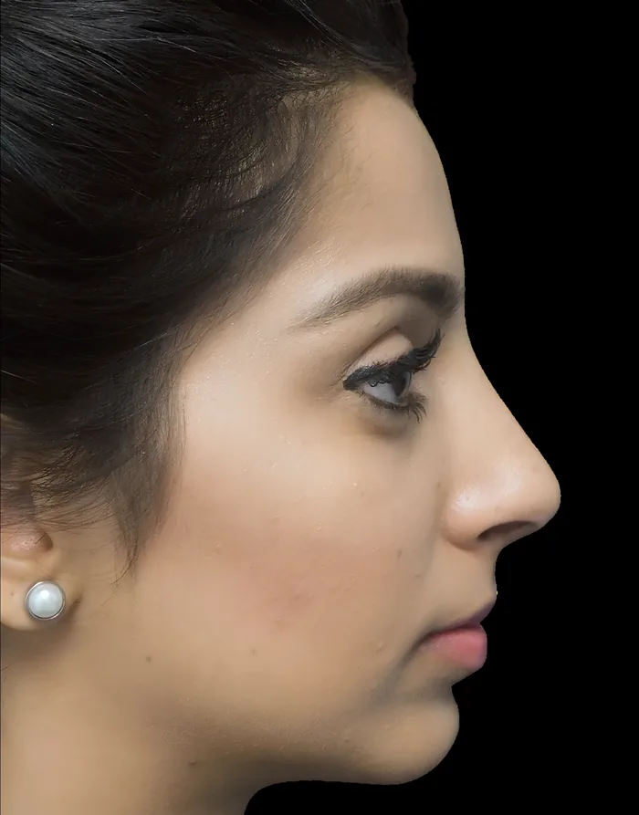 Rhinoplasty before, RHIN-001