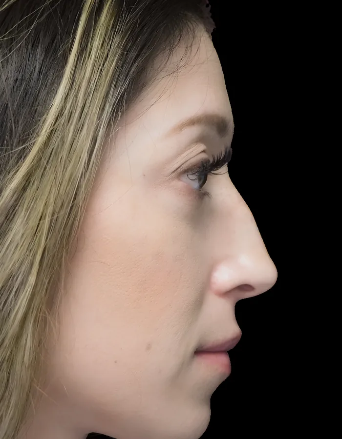 Rhinoplasty after, RHIN-002