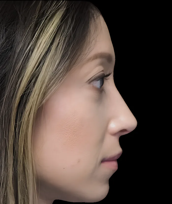 Rhinoplasty before, RHIN-002
