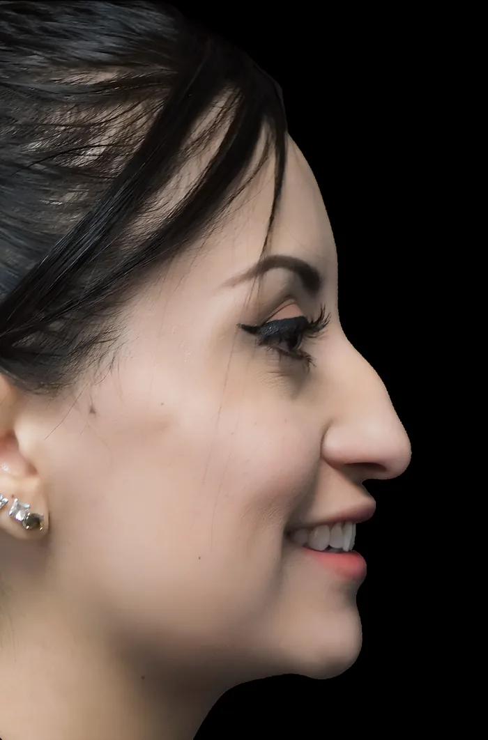 Rhinoplasty after, RHIN-003