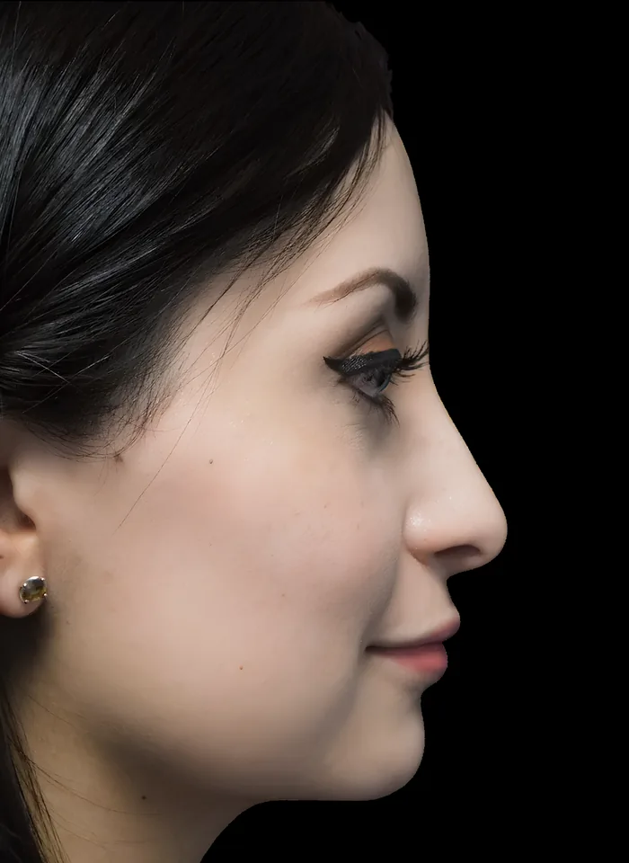 Rhinoplasty before, RHIN-003