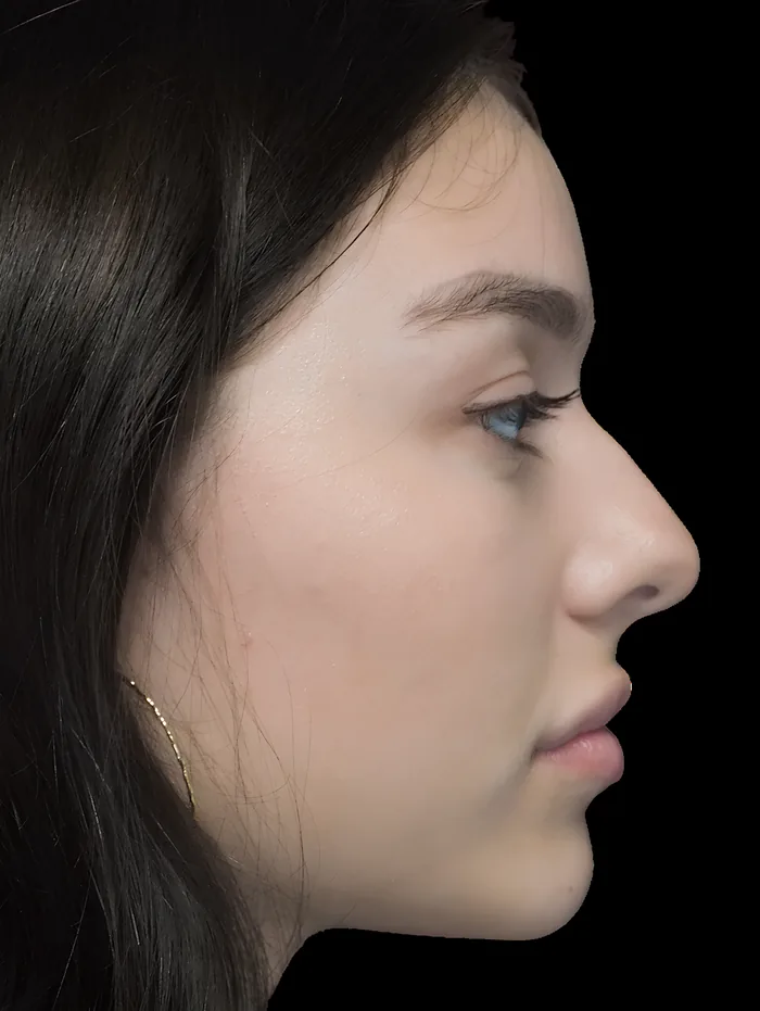 Rhinoplasty after, RHIN-004