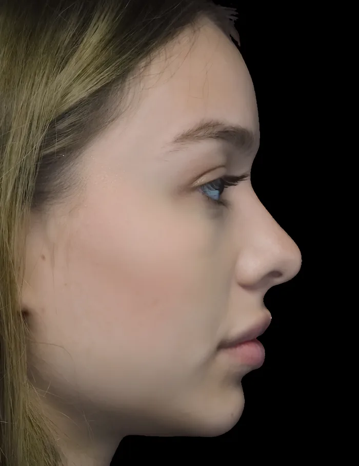 Rhinoplasty before, RHIN-004