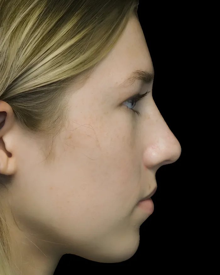Rhinoplasty after, RHIN-006