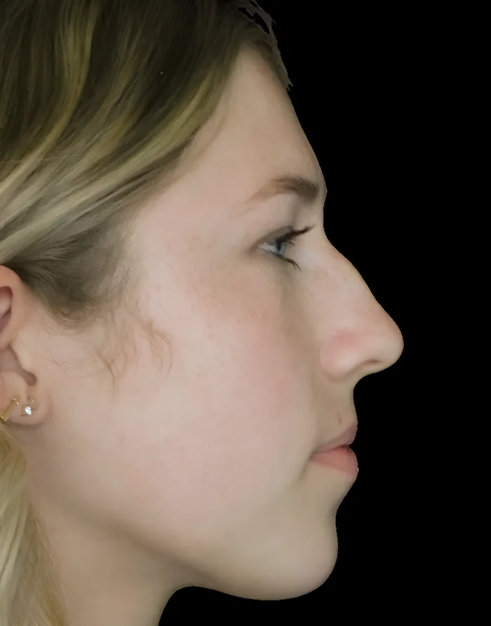 Rhinoplasty before, RHIN-006